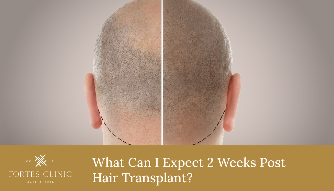 2 Weeks Post Hair Transplant