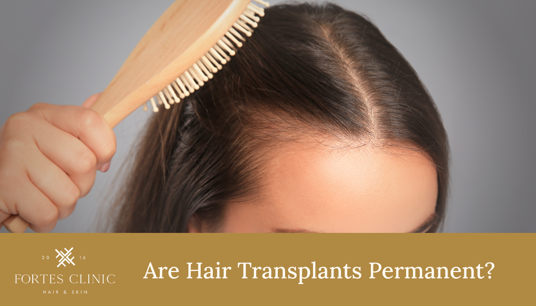 Are Hair Transplants Permanent?