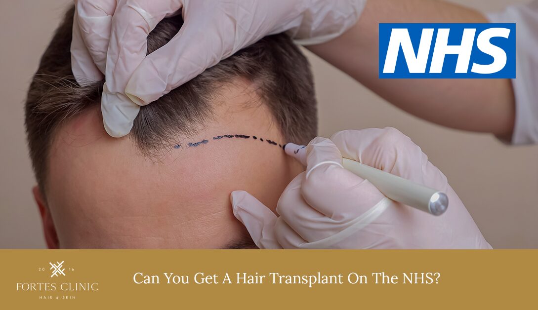 Can You get A Hair Transplant On The NHS?