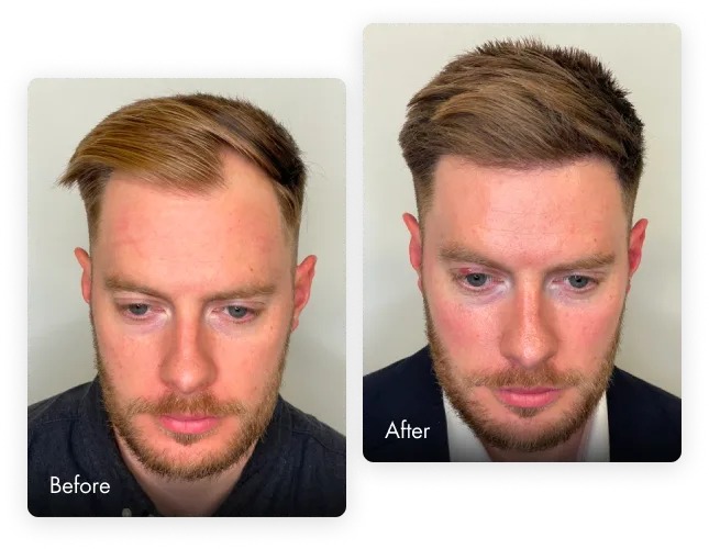 hair transplant recovery, hair transplant results timeline, hair transplant growth timeline, six months after hair transplant