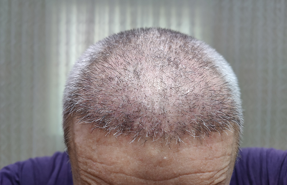hair transplant recovery timeline, hair transplant recovery, hair transplant aftercare, hair transplant growth timeline