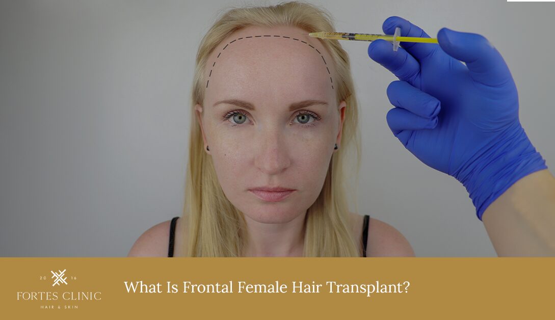Frontal Female Hair Transplant