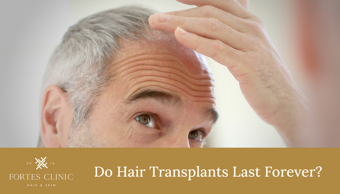 Do Hair Transplants Last Forever?