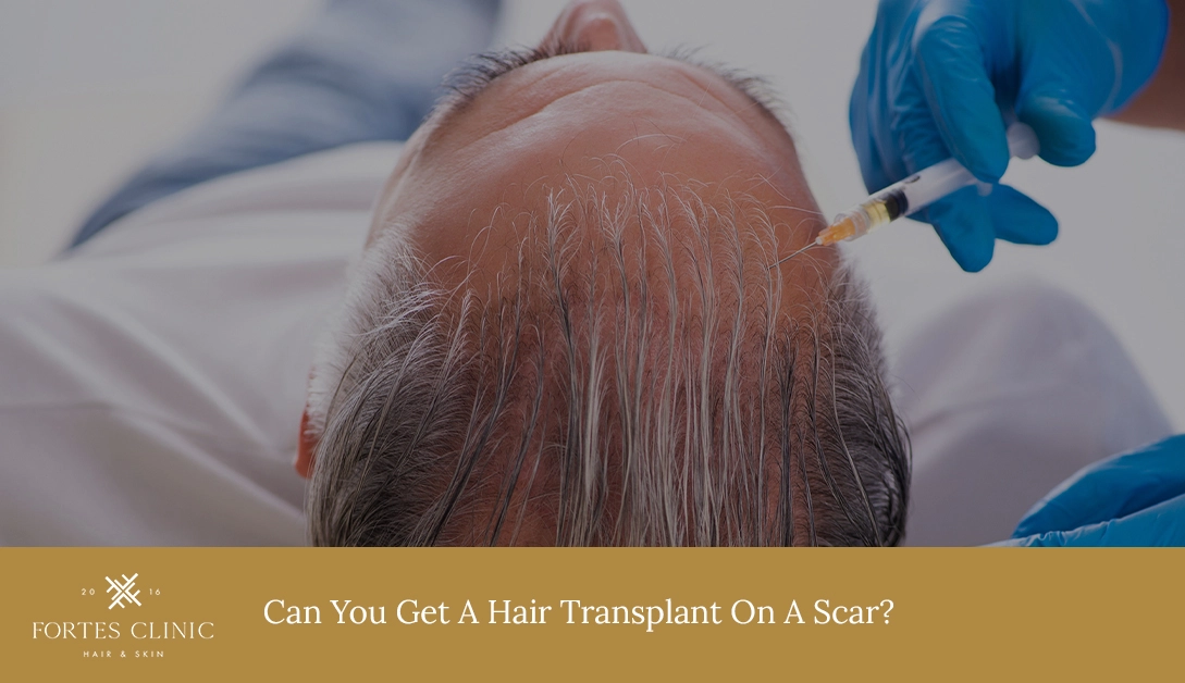 Hair Transplant On A Scar