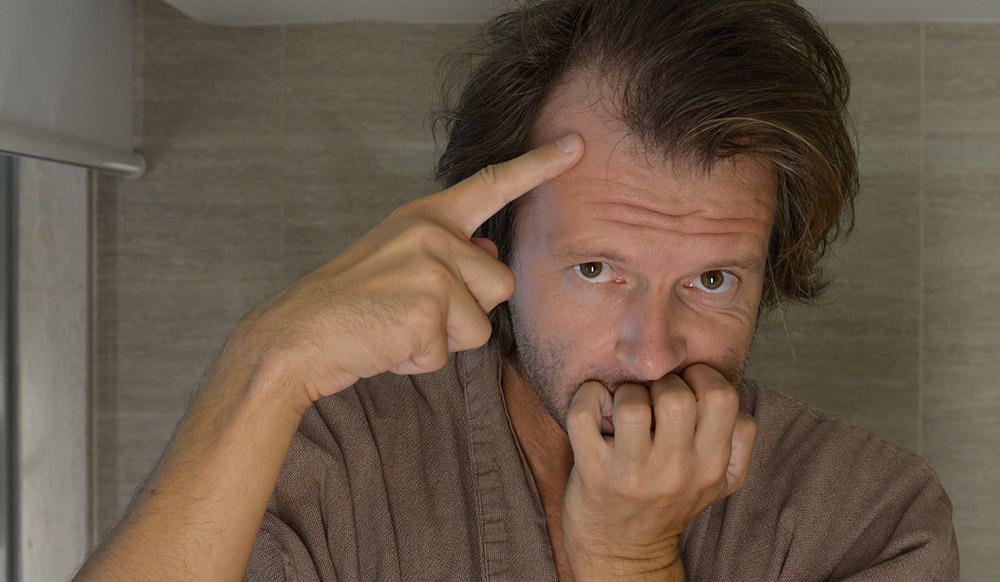 early signs of male pattern baldness, receding hairline early stage, temple recession