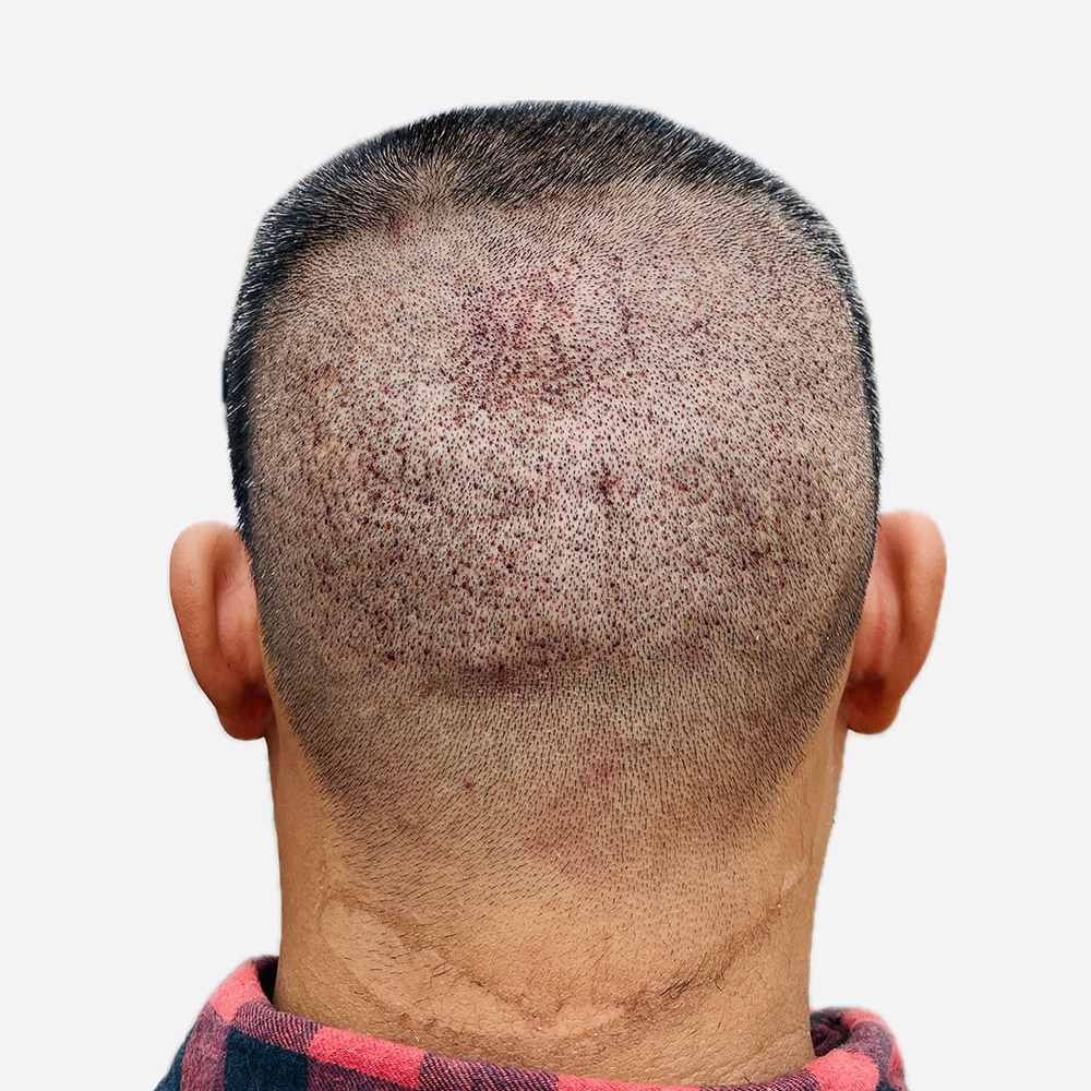what happens to donor area after hair transplant, hair transplant donor area, donor area healing,