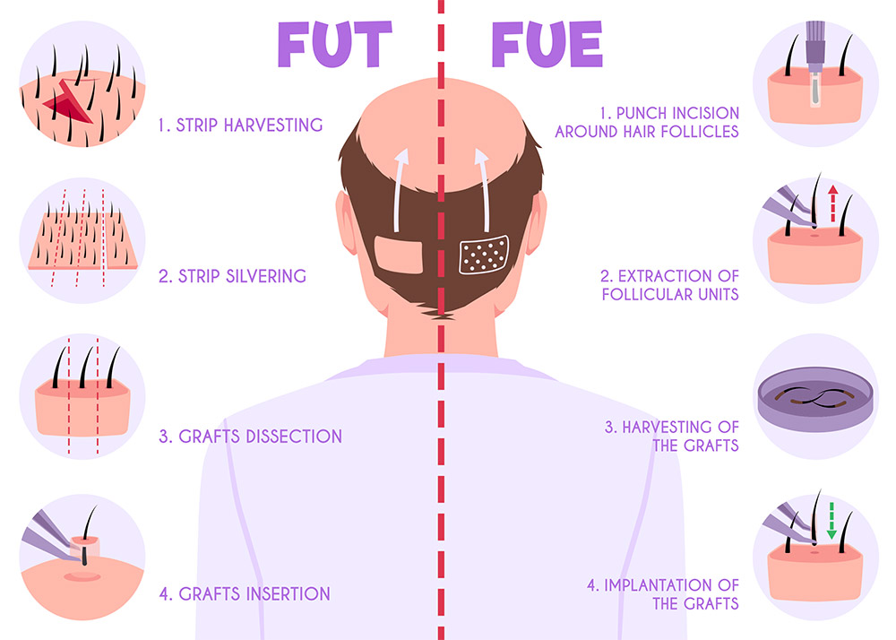 FUE vs FUT, FUE hair transplant, FUT hair transplant, donor harvesting