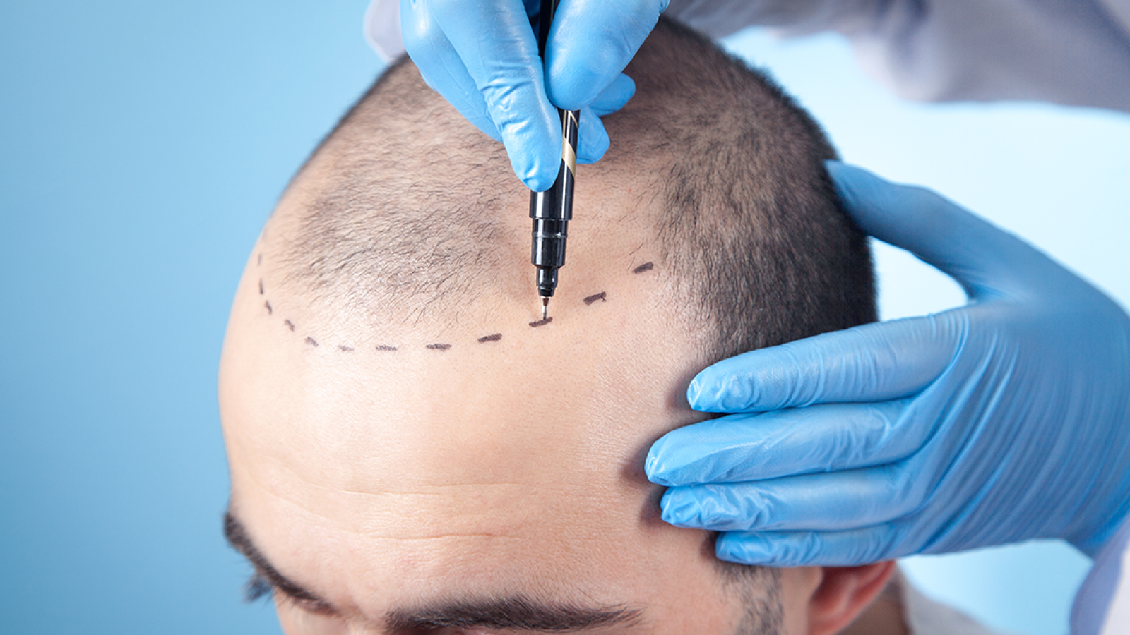6464a6df74ba66efc44911e4_Fortes-Clinic-Hair-Treatment-5