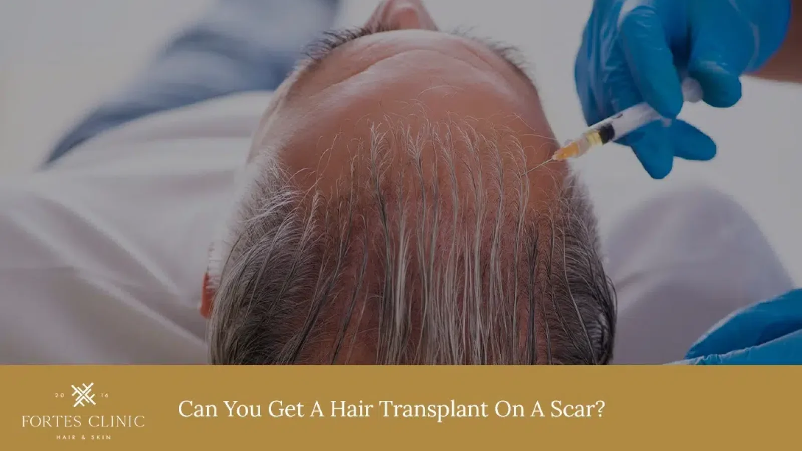 Can-You-Get-A-Hair-Transplant-On-A-Scar_