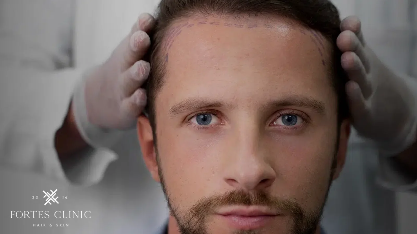 How-Long-Does-A-Hair-Transplant-Last_