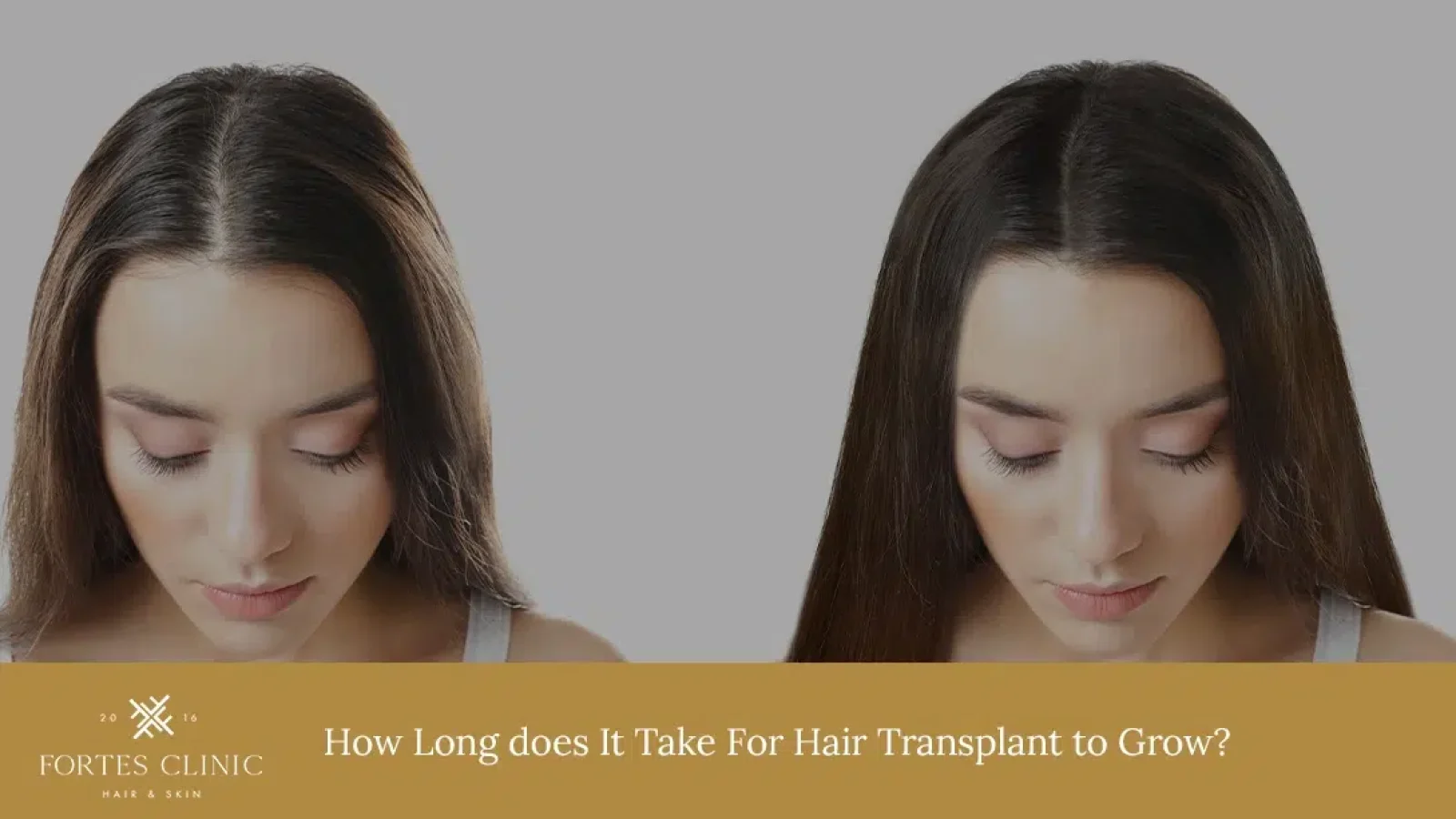 How-Long-does-It-Take-For-Hair-Transplant-to-Grow_