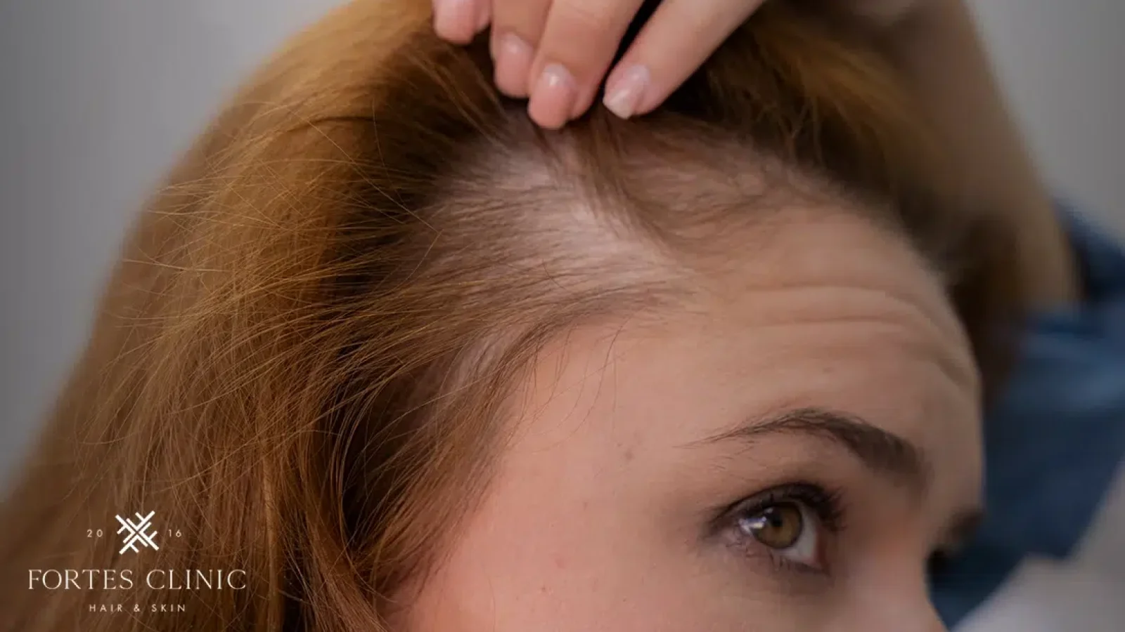 Treatment-Options-For-Women-With-Thinning-Hair