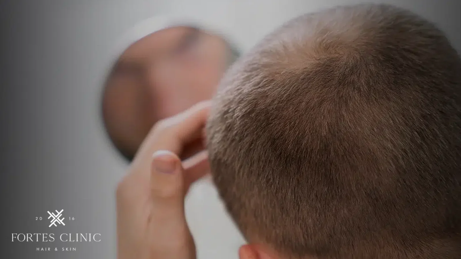 Understanding-Traction-Alopecia-1