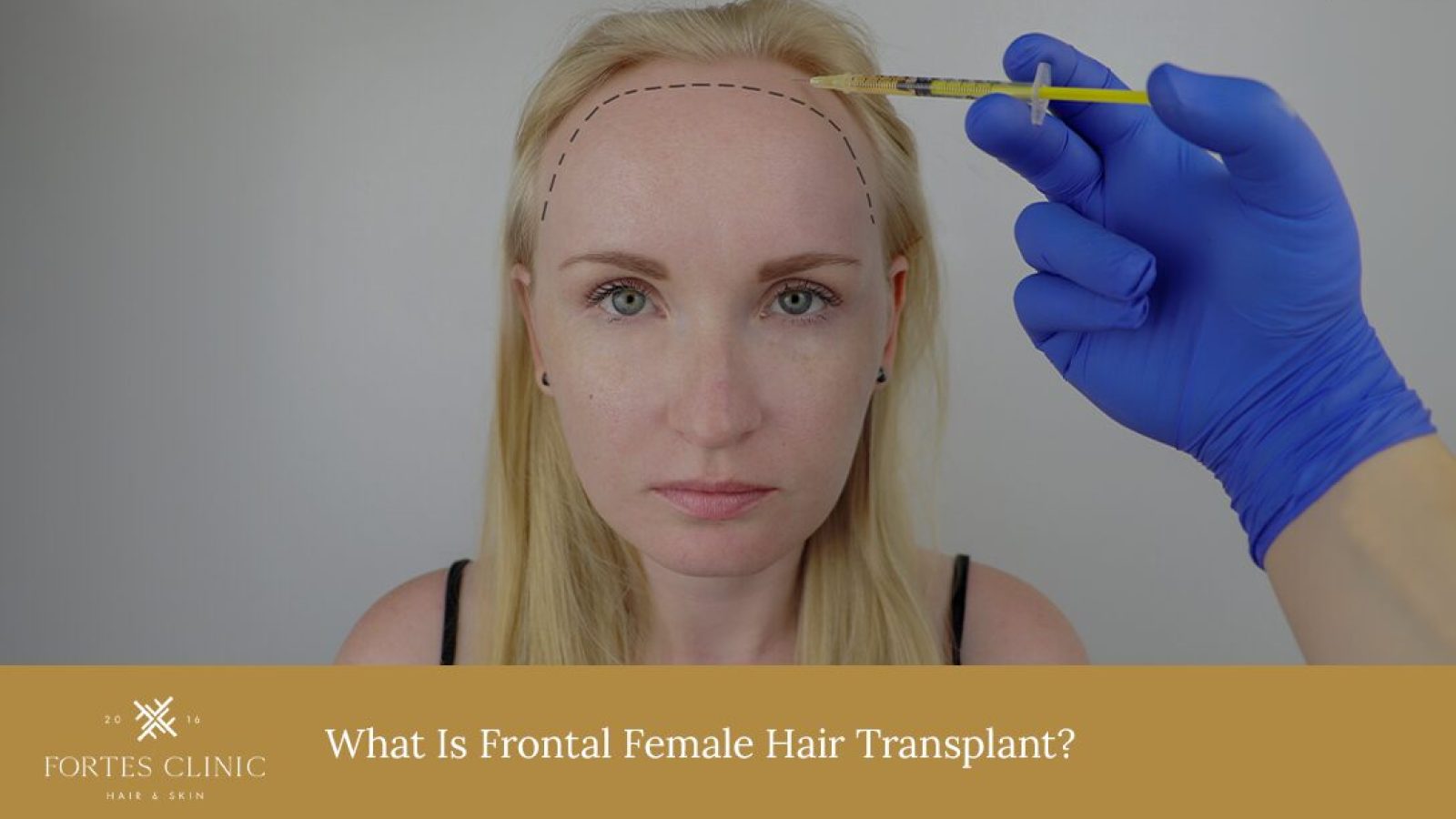 What-Is-Frontal-Female-Hair-Transplant__
