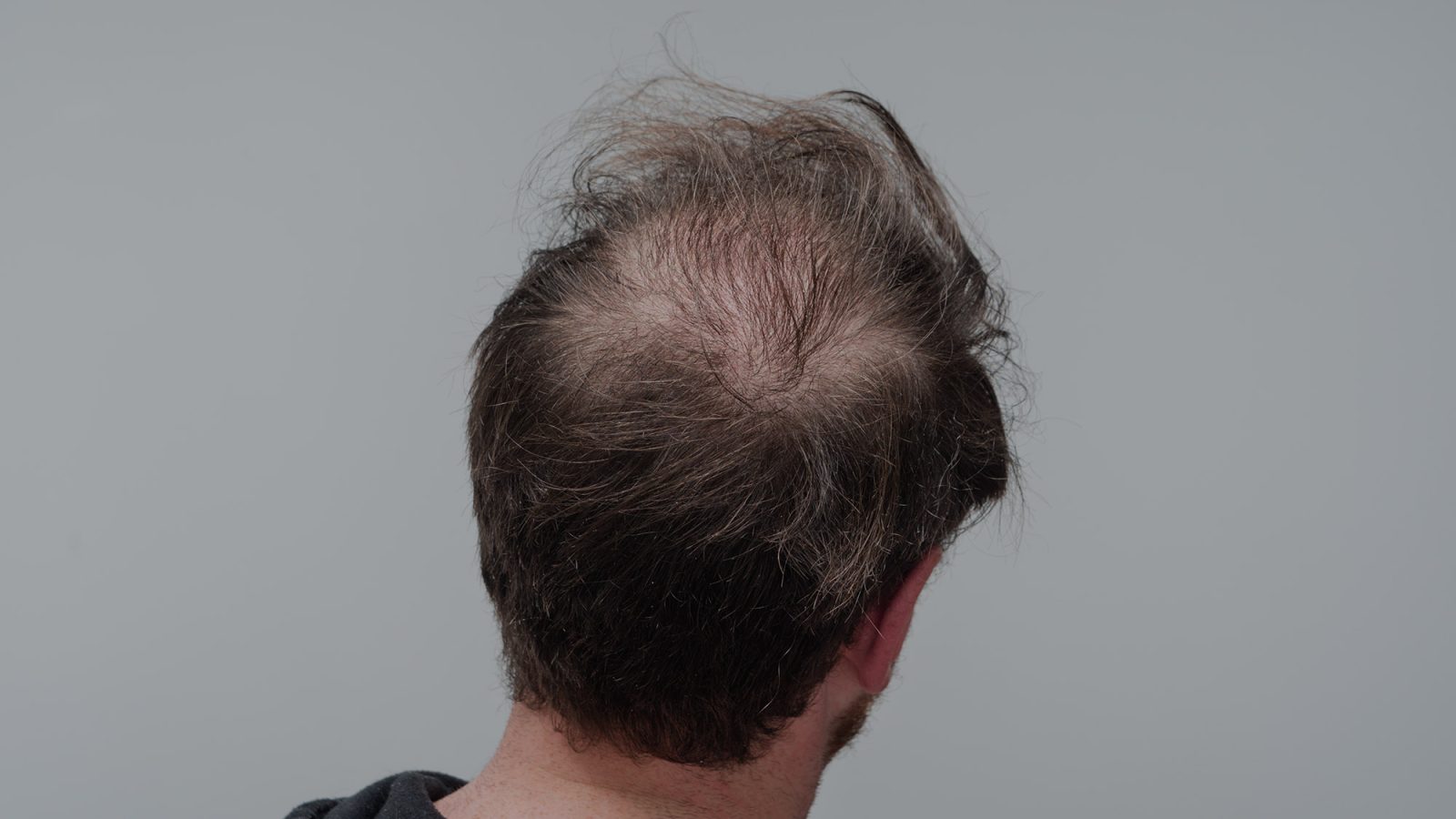 early signs of male pattern baldness