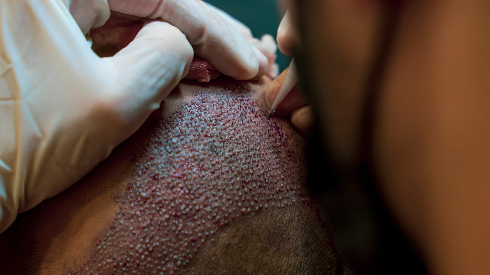 hair transplant cost UK, FUE hair transplant cost, FUT hair transplant cost, hair transplant pricing